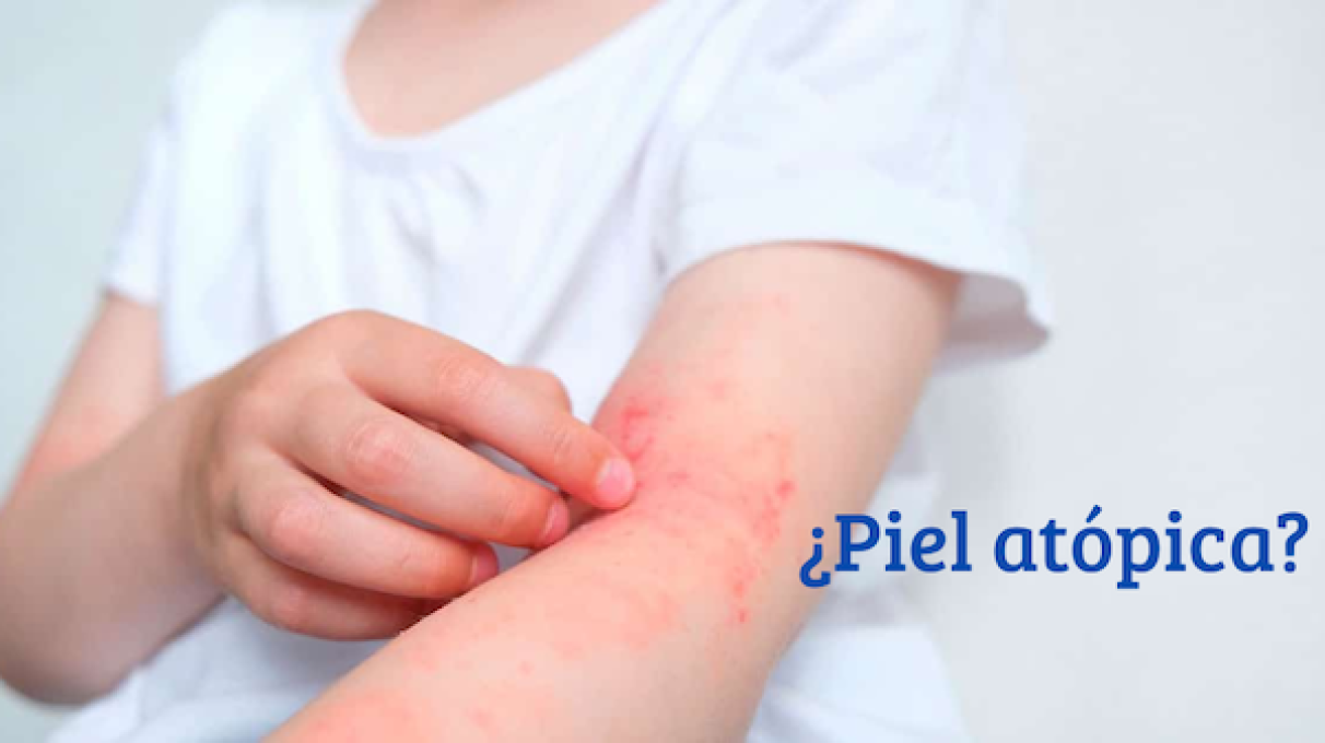¿Qué es la piel atópica? Consejos  para cuidar tu piel